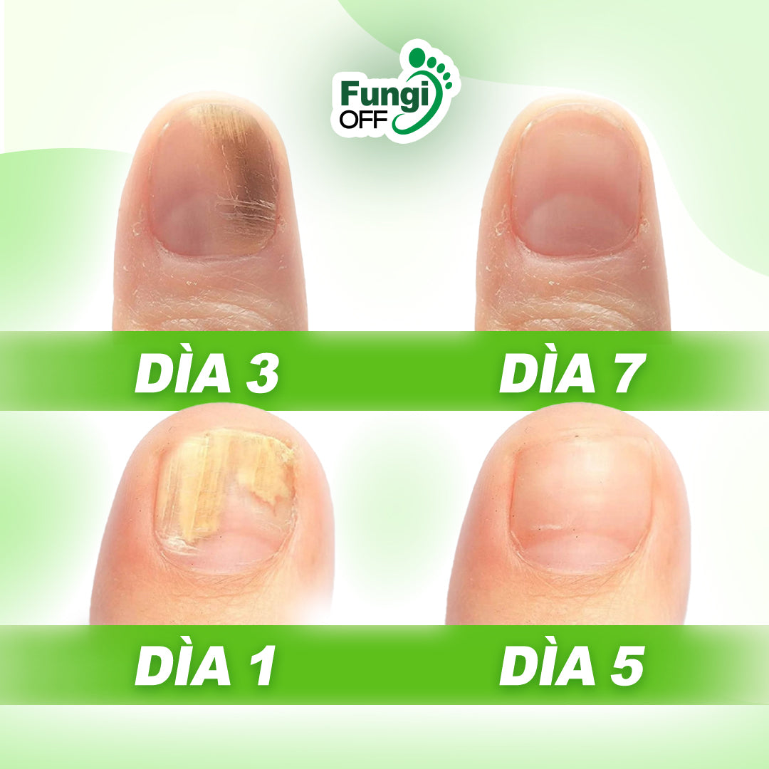 ¡1 + 1 GRATIS! Fungi Off® - ¡LAS GOTAS que ELIMINAN HONGOS, HEMATOMAS y DOLOR en tus PIES!