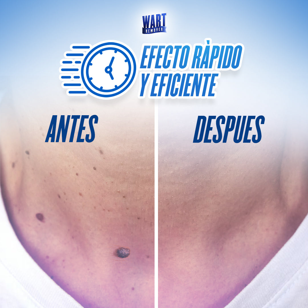 ¡1+ 1 GRATIS! Wart Remover® - ¡La SOLUCIÓN para ELIMINAR VERRUGAS y LUNARES sin DOLOR!