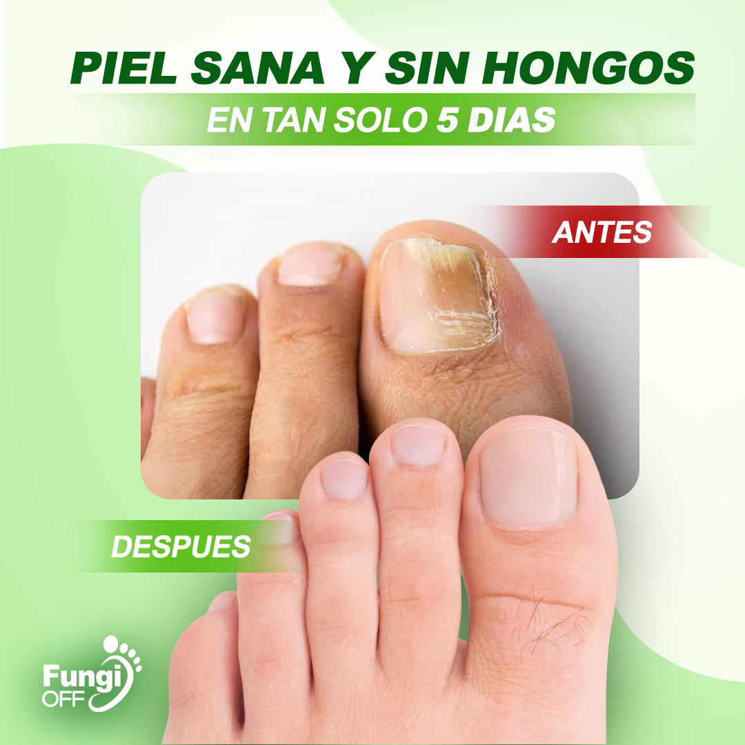 ¡1 + 1 GRATIS! Fungi Off® - ¡LAS GOTAS que ELIMINAN HONGOS, HEMATOMAS y DOLOR en tus PIES!