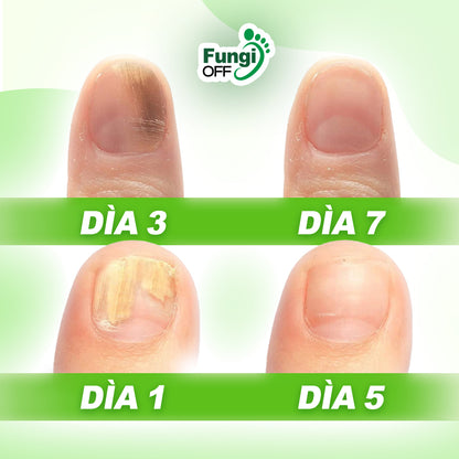 ¡1 + 1 GRATIS! Fungi Off® - ¡LAS GOTAS que ELIMINAN HONGOS, HEMATOMAS y DOLOR en tus PIES!