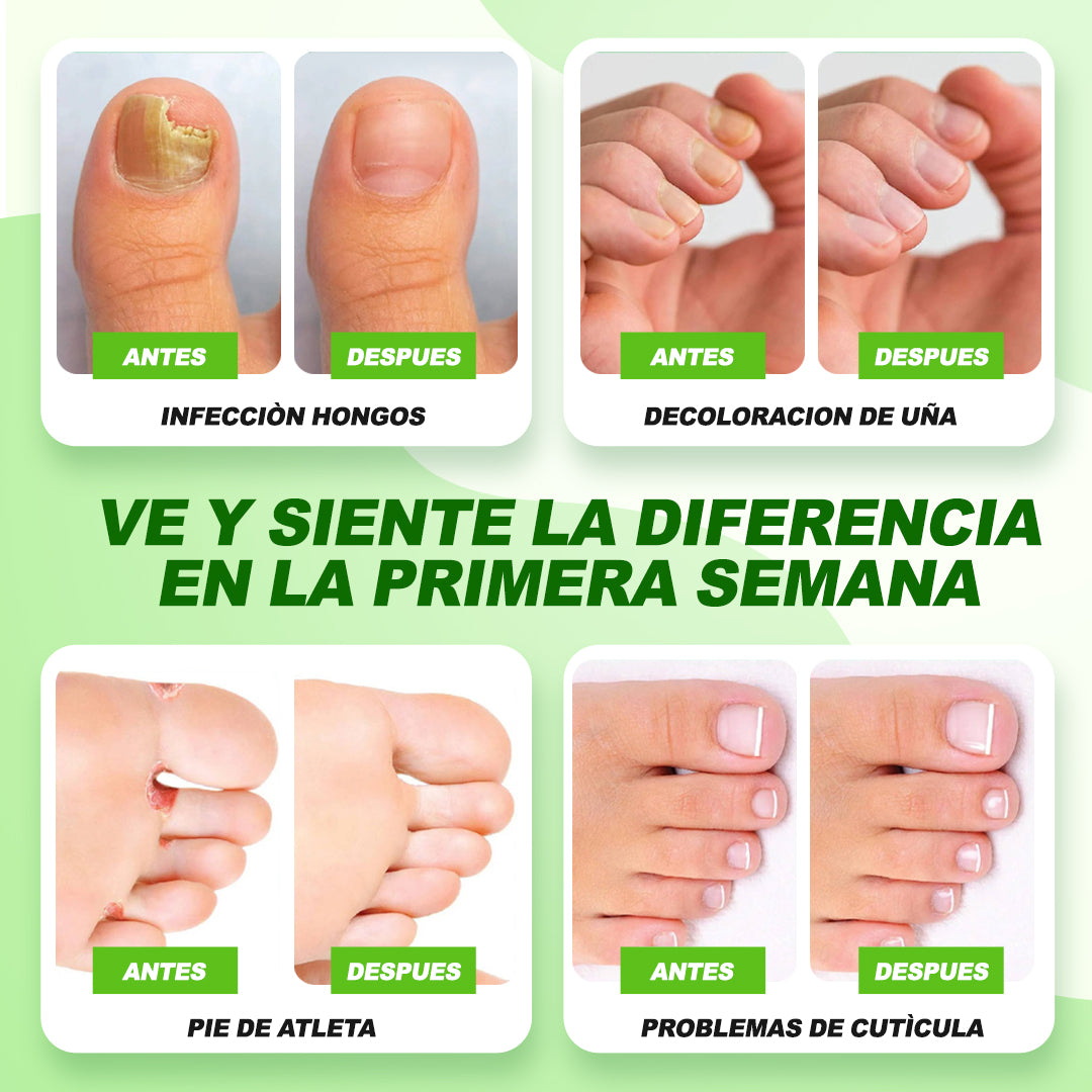 ¡1 + 1 GRATIS! Fungi Off® - ¡LAS GOTAS que ELIMINAN HONGOS, HEMATOMAS y DOLOR en tus PIES!