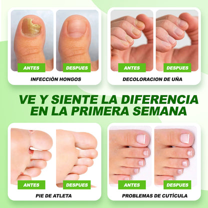 ¡1 + 1 GRATIS! Fungi Off® - ¡LAS GOTAS que ELIMINAN HONGOS, HEMATOMAS y DOLOR en tus PIES!