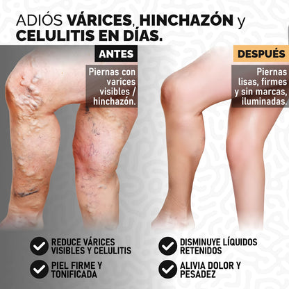 BodyLift® Serum - Reductor y reafirmante con acción drenante y anti-varices | 1+1 GRATIS